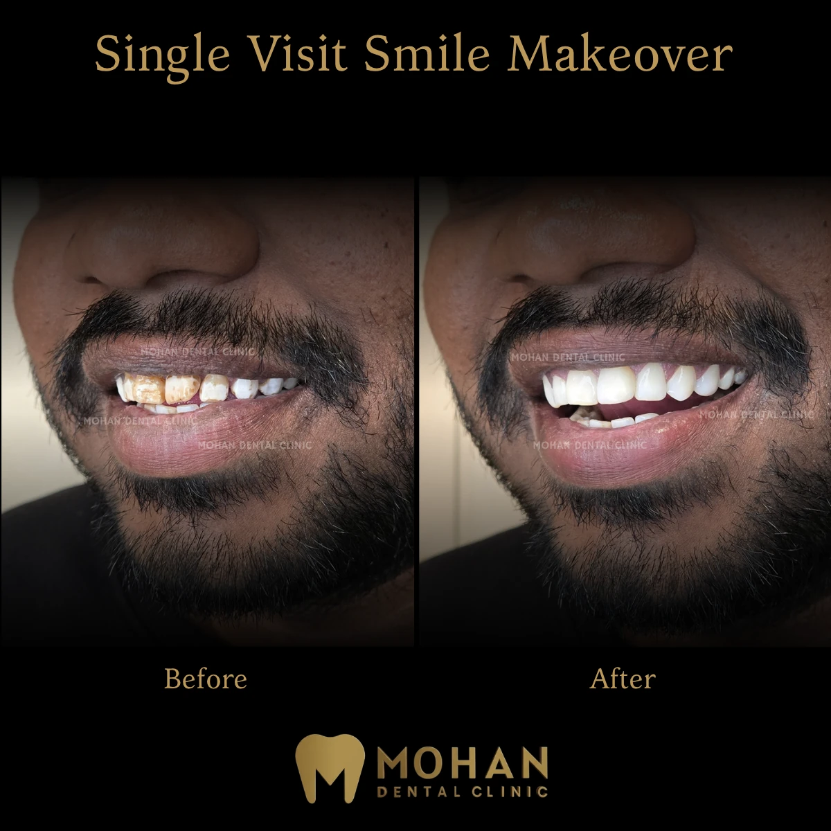 Single Visit Fluorosis Treatment