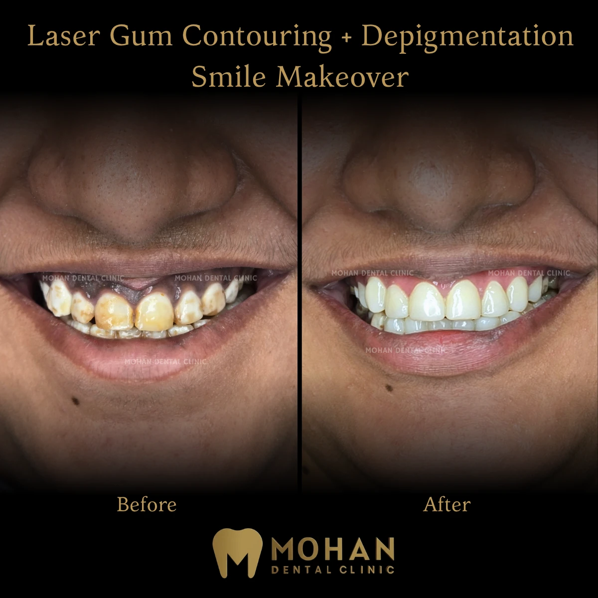 Gum Contouring + Makeover