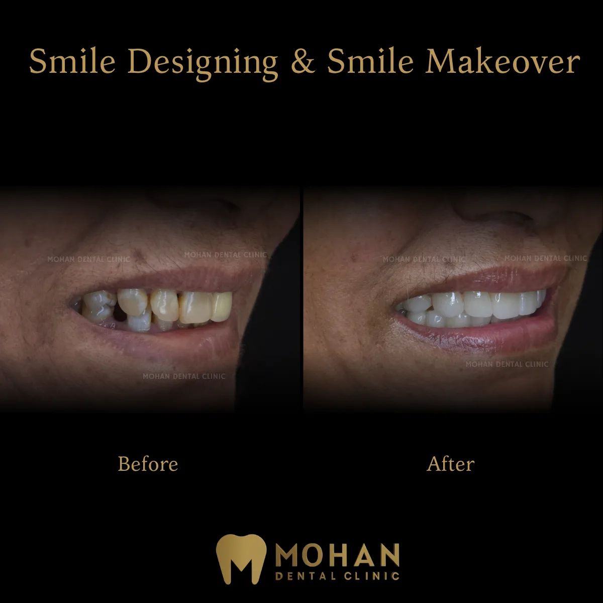 Smile Designing