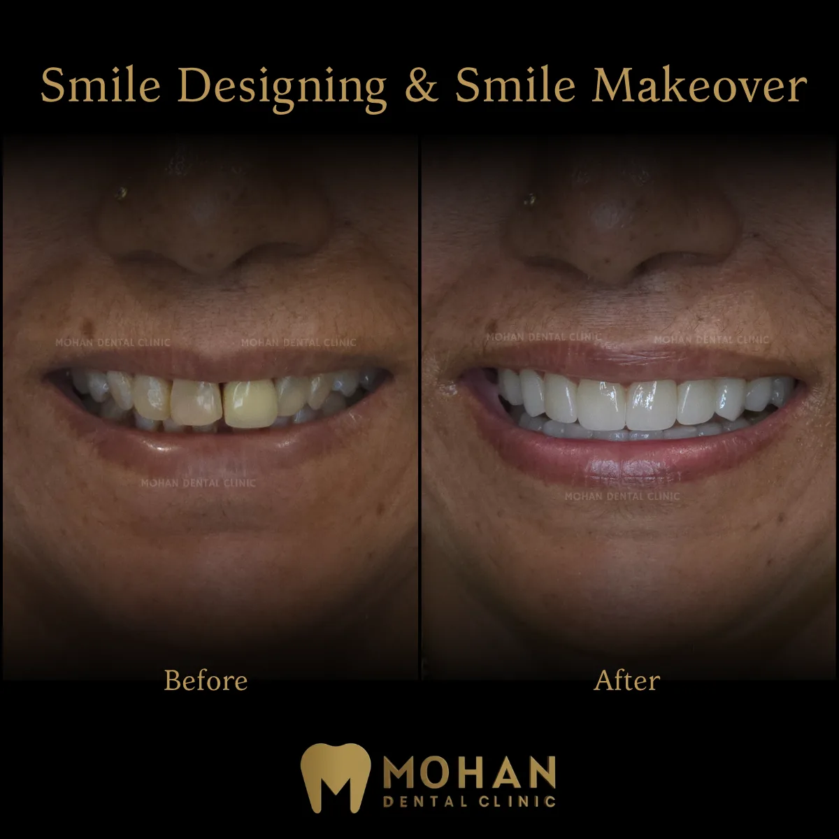 Smile Makeover
