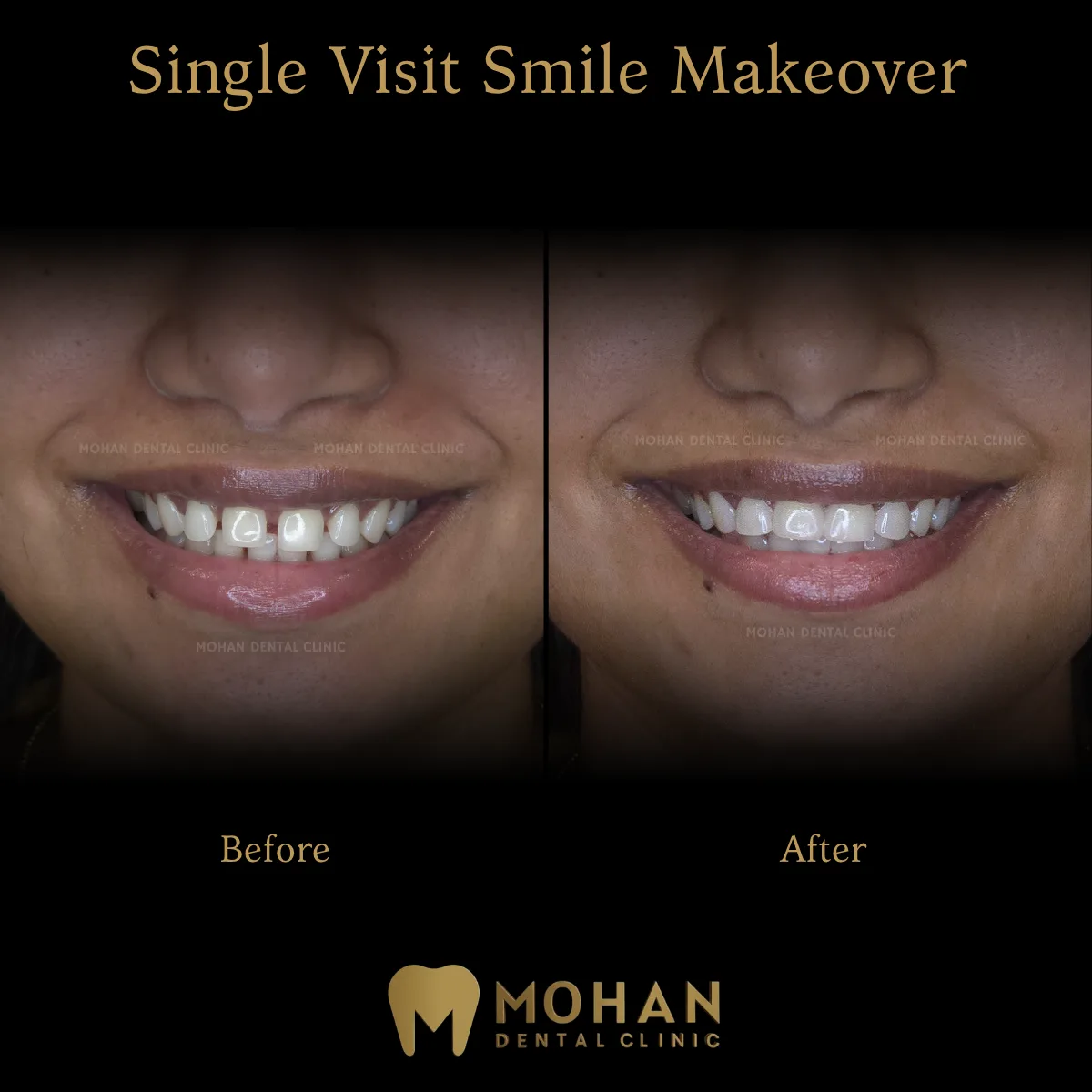 Single Visit Smile Makeove