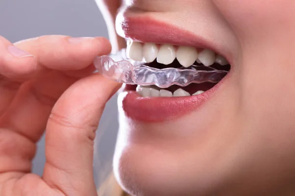 Aligners
    Straight teeth without metal braces