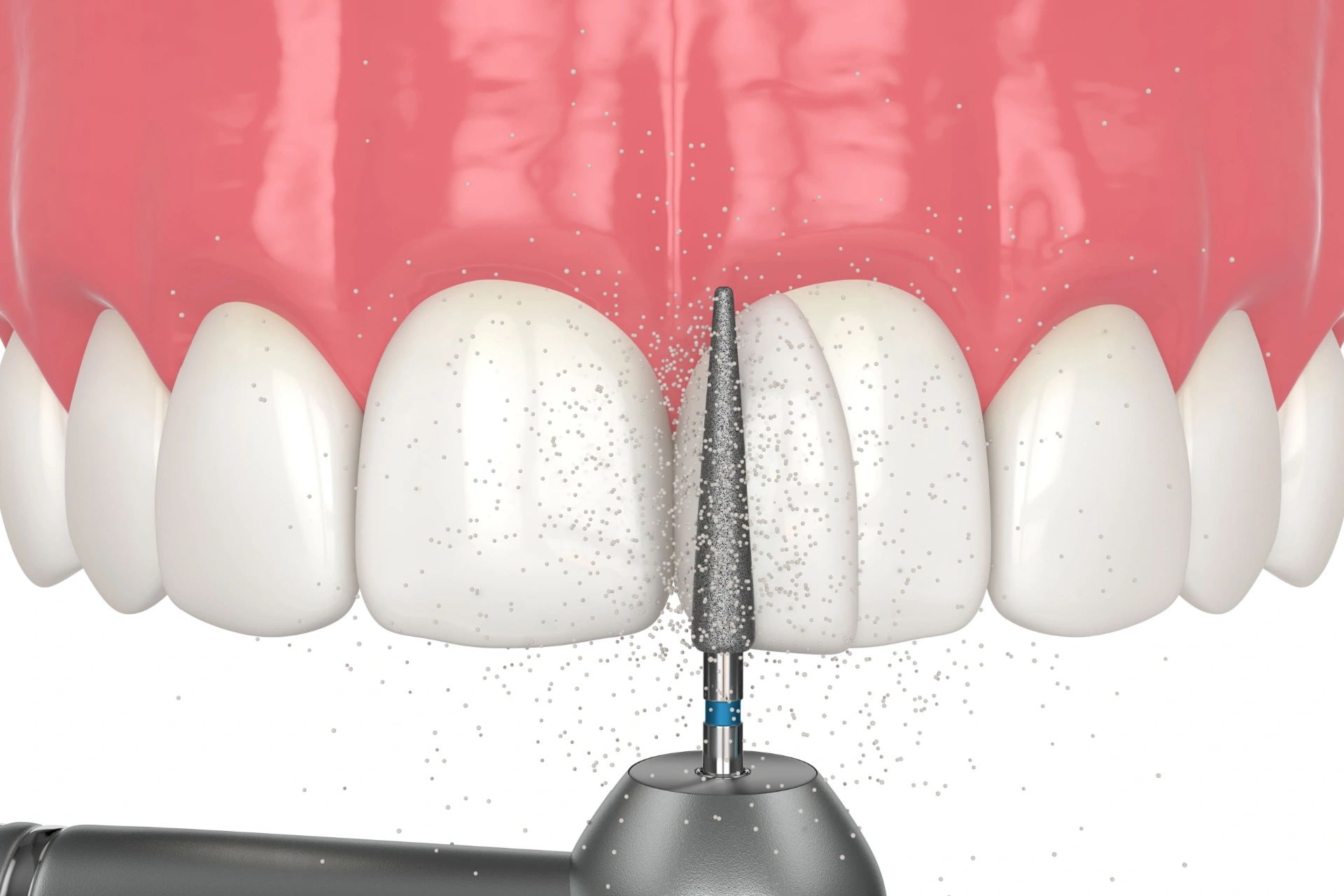 Composite Bonding
    Reshape & repair with precision