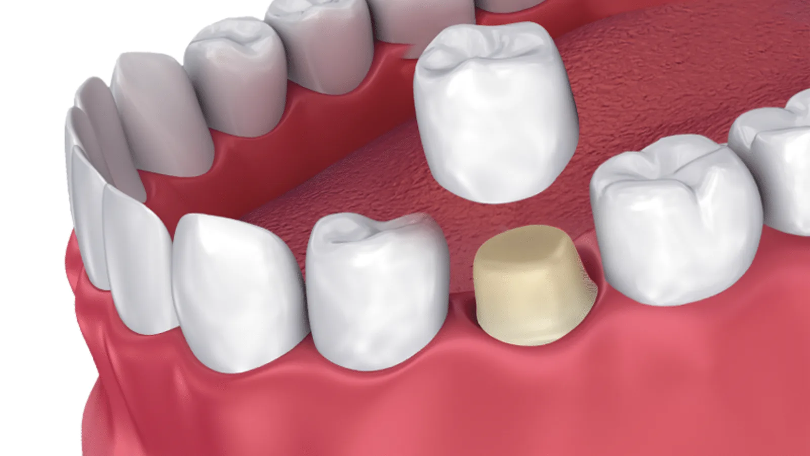 Dental Crowns
    Protect & restore damaged teeth