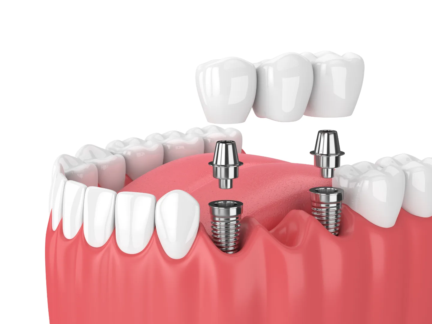 Dental Implants
    Permanent solution for missing teeth
