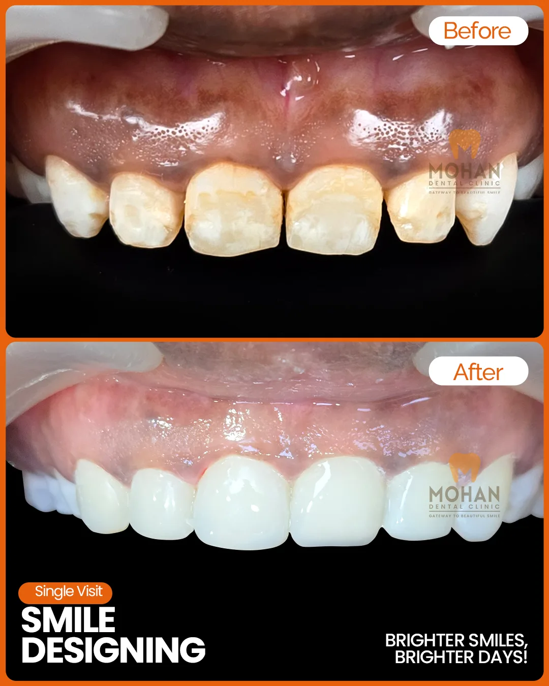 Gum Depigmentation
    Restore healthy pink gums