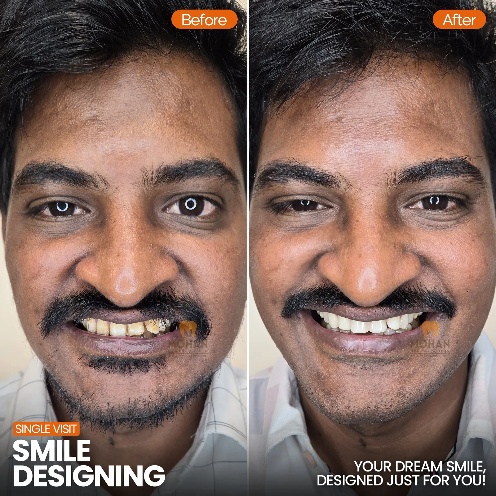 Gummy Smile Correction
    Reveal more of your beautiful teeth