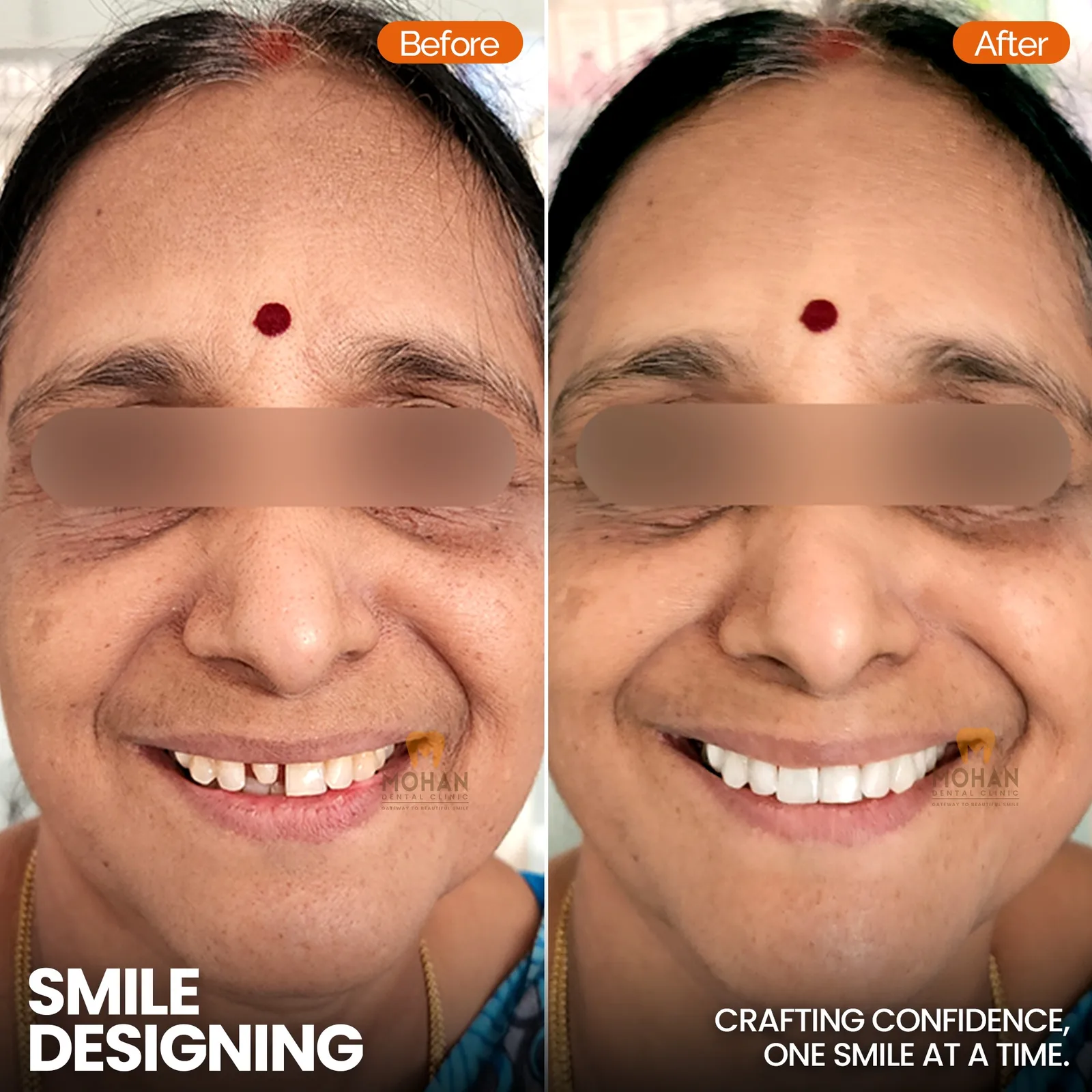 Smile Correction
    Fix gaps, chips & uneven teeth