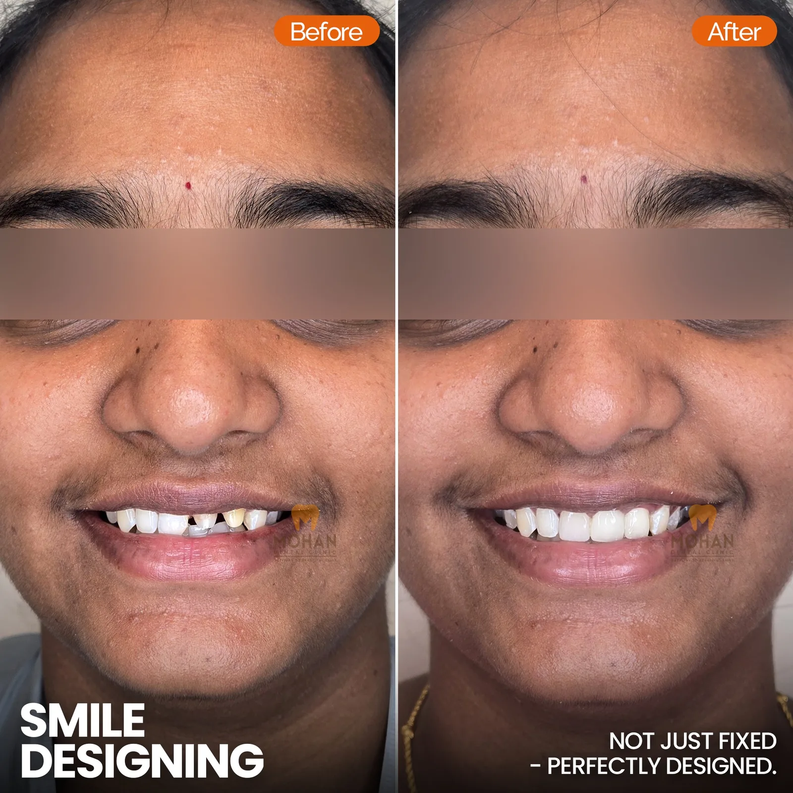 Smile Makeover Correction
    Complete smile transformation in one visit