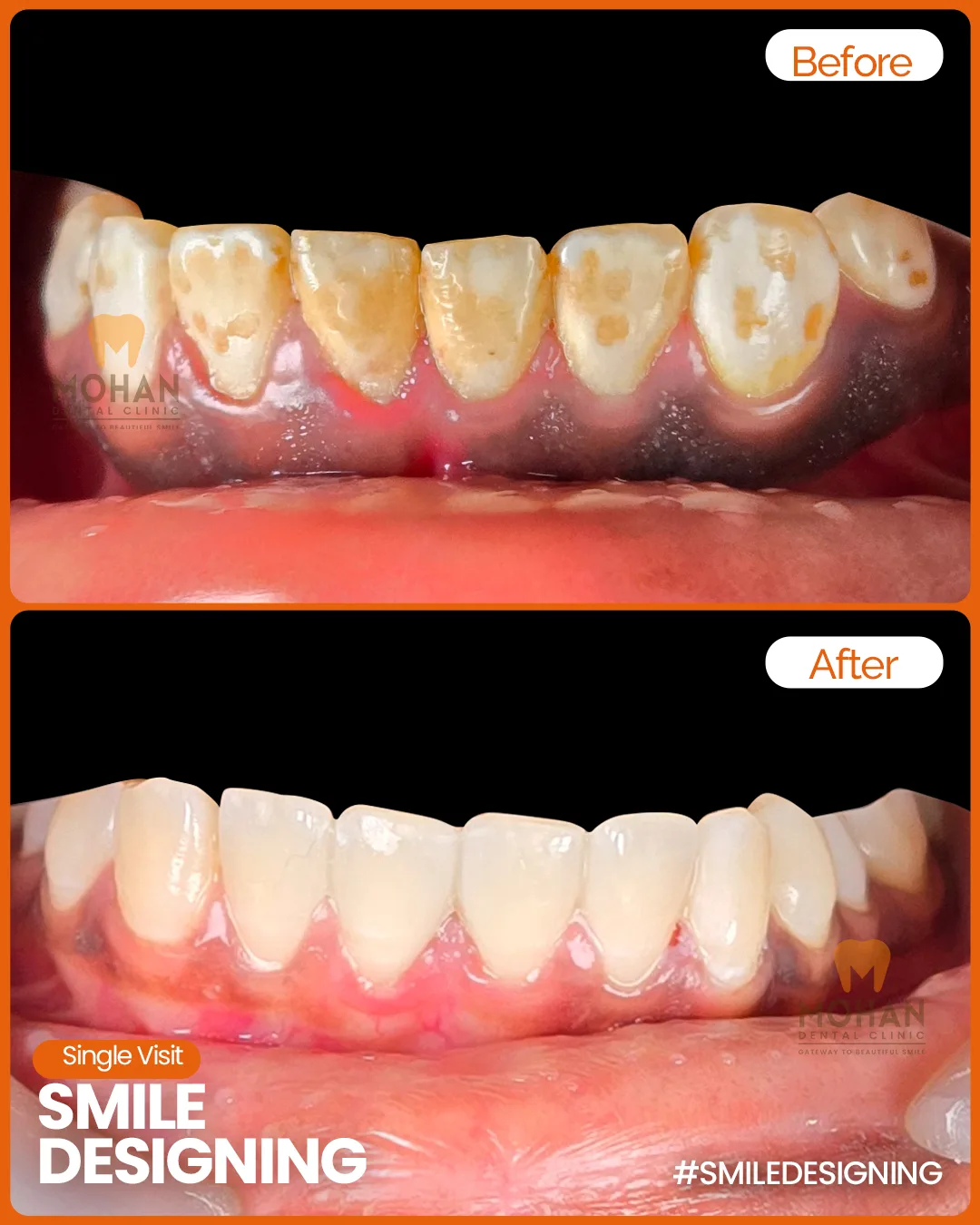 Teeth Whitening
    Brighter smile in under an hour